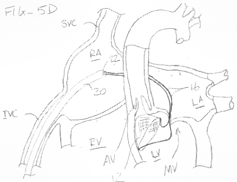 emboline TAVR